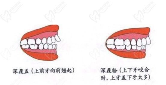 牙齿深覆合和深覆盖区别