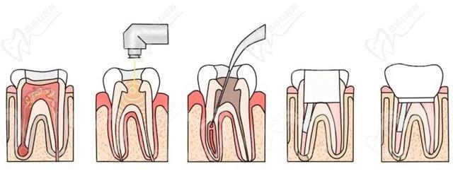 根管治疗过程示意图