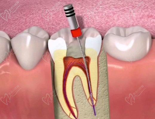 扩孔针取牙髓示意图
