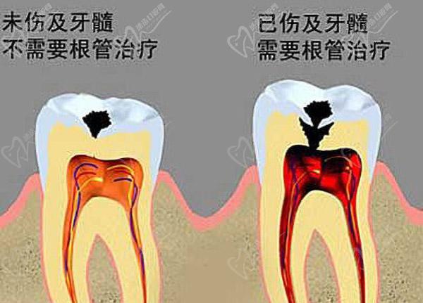 牙髓病是牙髓组织的疾病