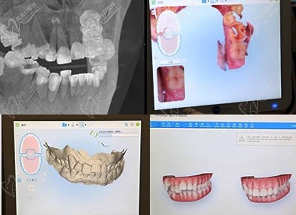 深圳福华口腔医院数字化矫正技术