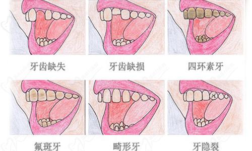 什么情况下需要做牙齿修复