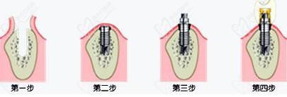 种植牙手术过程图解