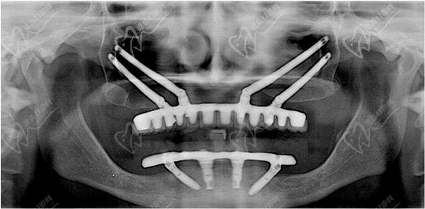 all-on-4种植牙种植体在口腔内的植入牙片