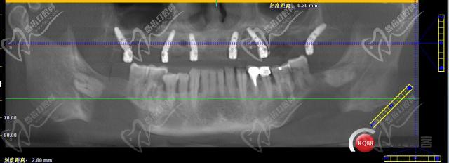 all-on-6种植牙种植体在口腔内的植入牙片