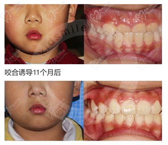 儿童地包天早期干预面形颌牙齿图
