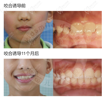 儿童偏颌早期干预面形颌牙齿图