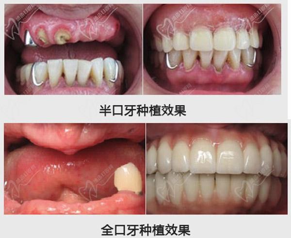 东莞同步齿科门诊部郝安医生种植牙案例