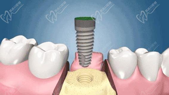 牙槽骨吸收了还可以种植牙吗？