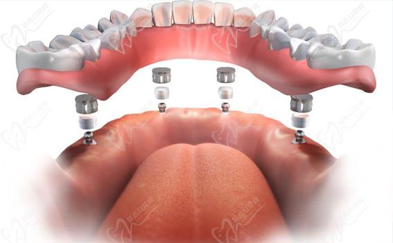 有牙槽骨吸收的情况，医生会建议使用ALL-ON-4/6半全口种植牙