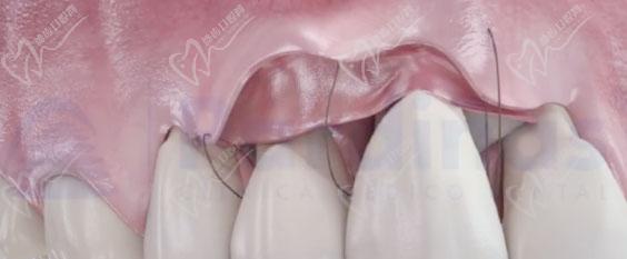 牙龈萎缩牙根外露怎么治疗根面覆盖术能恢复么