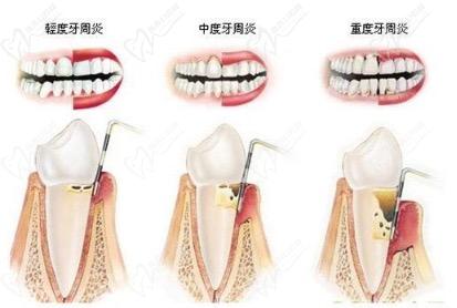 轻度、中度、重度牙周炎