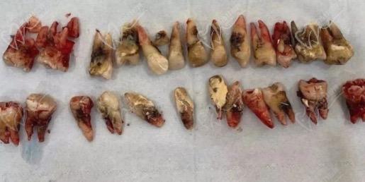 重度牙周炎拔牙