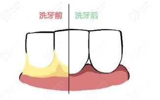 洁牙前后对比