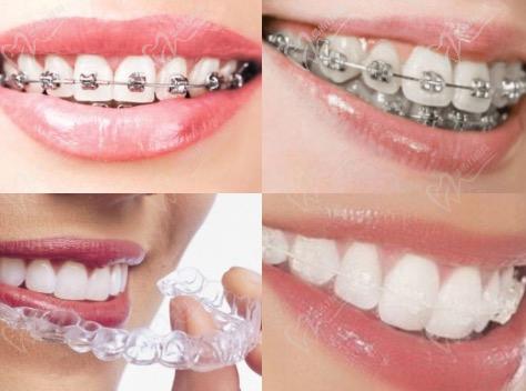 各种牙齿矫正方式对比
