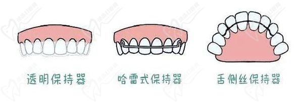 牙齿矫正保持器种类
