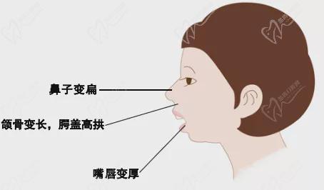 长期口呼吸形成的腺样体容貌