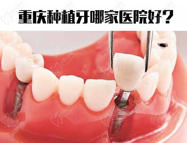 重庆做种植牙哪家医院好？