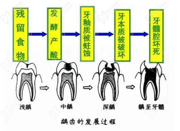 深圳补牙哪里好?希奥口腔3m瓷化树脂补牙360元一颗,看网友效果图咋样_