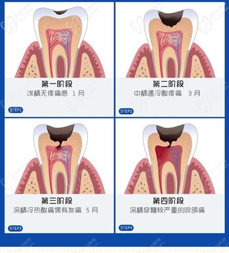 龋齿一般可分为三个阶段：浅龋、中龋、深龋