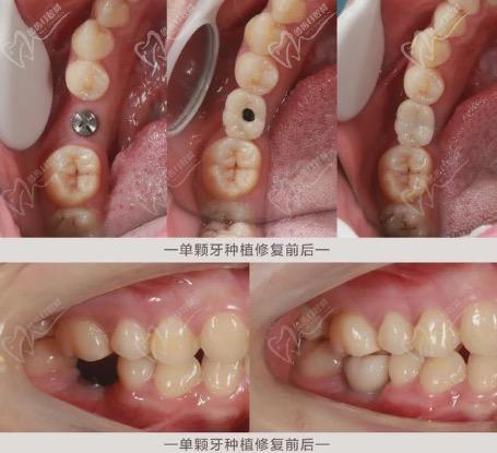 种植牙修复前后效果对比