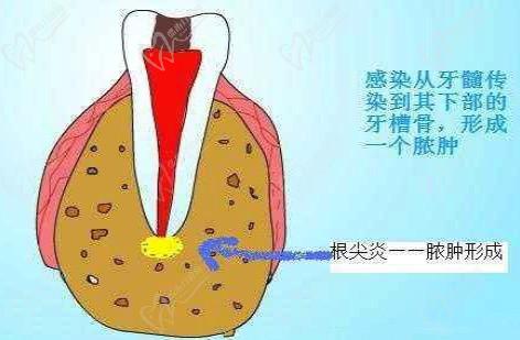 种植牙后形成瘘管