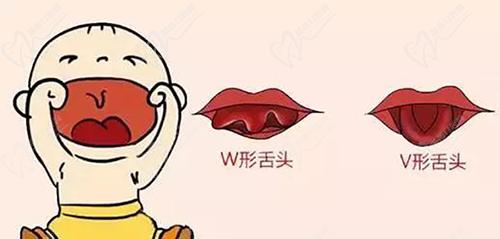 舌系带过短判断标准