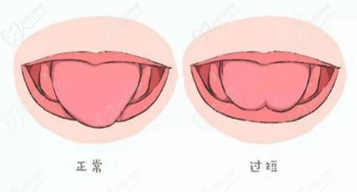 舌系带过短示意图