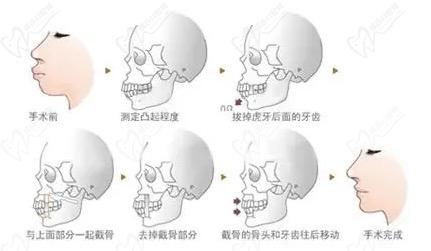 正颌手术过程