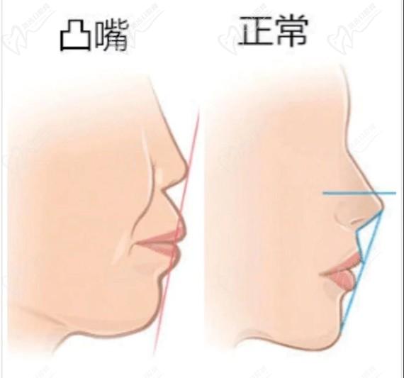 凸嘴颌正常面型对比