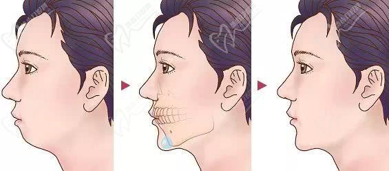 下巴后缩引起的凸嘴