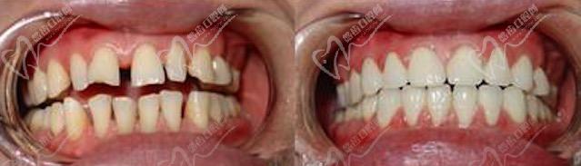 牙齿缺损较多采用全瓷牙修复效果