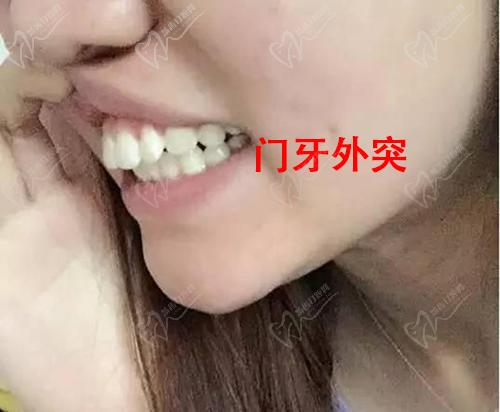 术前门牙外凸