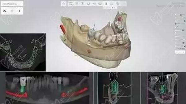 3D微创种植牙