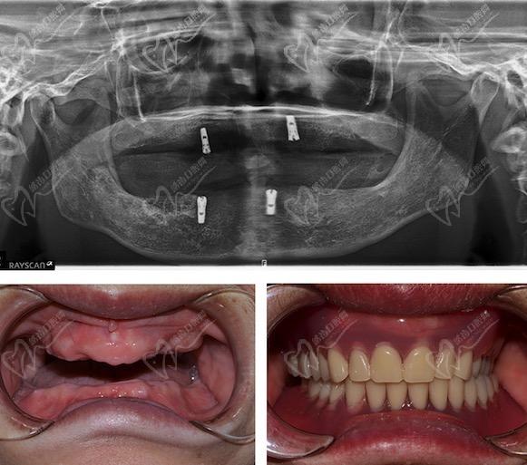 上海松丰齿科蒋勇军种植牙技术咋样？