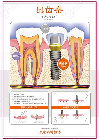 韩国奥齿泰种植体优势