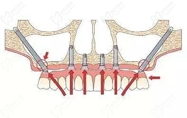穿颧穿翼种植牙示意图
