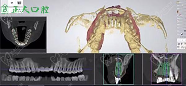 3D可视操作技术种牙