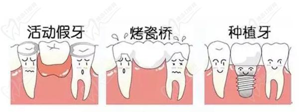 老人满口缺牙怎么办