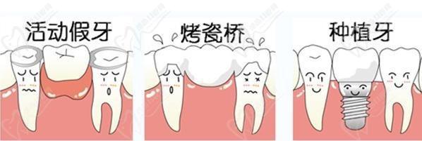 牙齿缺失多颗,是做种植牙好还是做镶牙好？