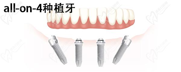 All-on-4种植牙