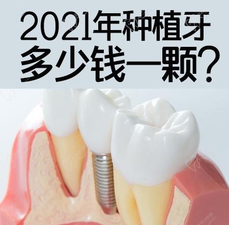2021年种植牙多少钱一颗？