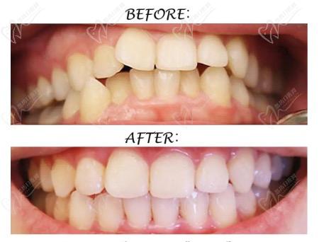 牙齿矫正前后效果对比