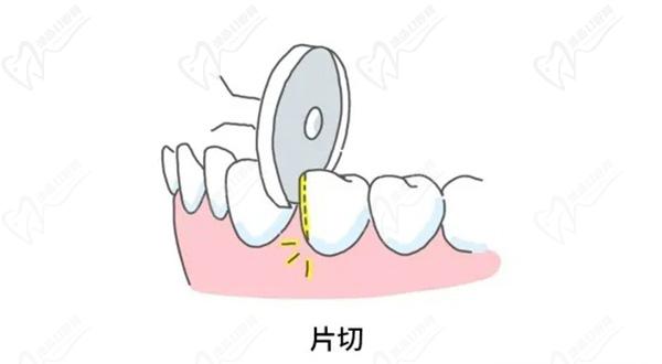 矫正牙齿片切过程