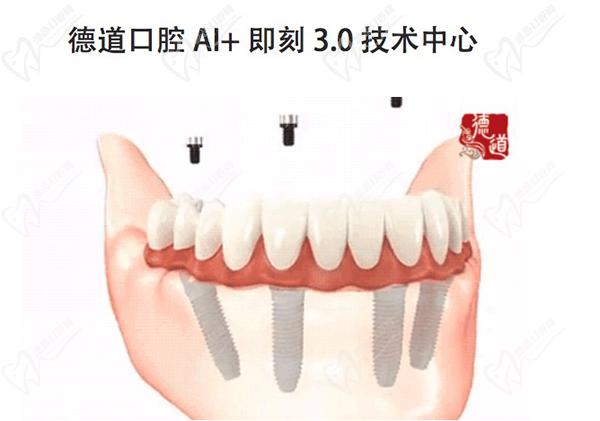 即刻用3.0种植牙技术