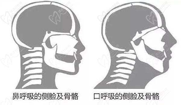 口呼吸危害