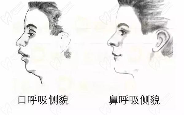 口呼吸危害
