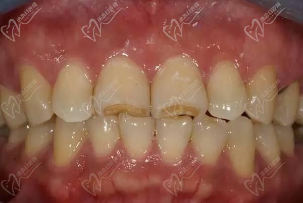 门牙长磨短3毫米后的对比照片