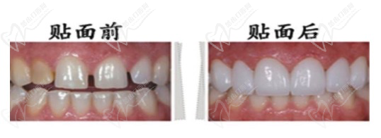门牙大可以磨小吗