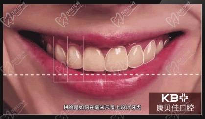 北京康贝佳口腔DSD微笑设计黄金曲线